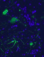 Neuronas dopaminérgicas con morfología alterada de un paciente parkinsoniano